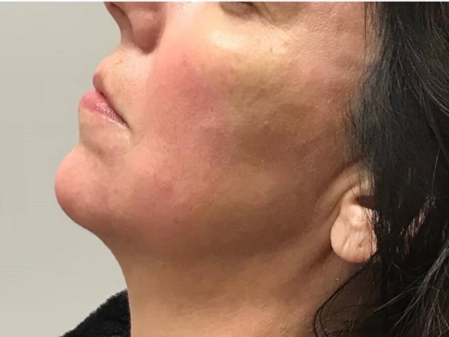 Juvederm Chin Enhancement After
