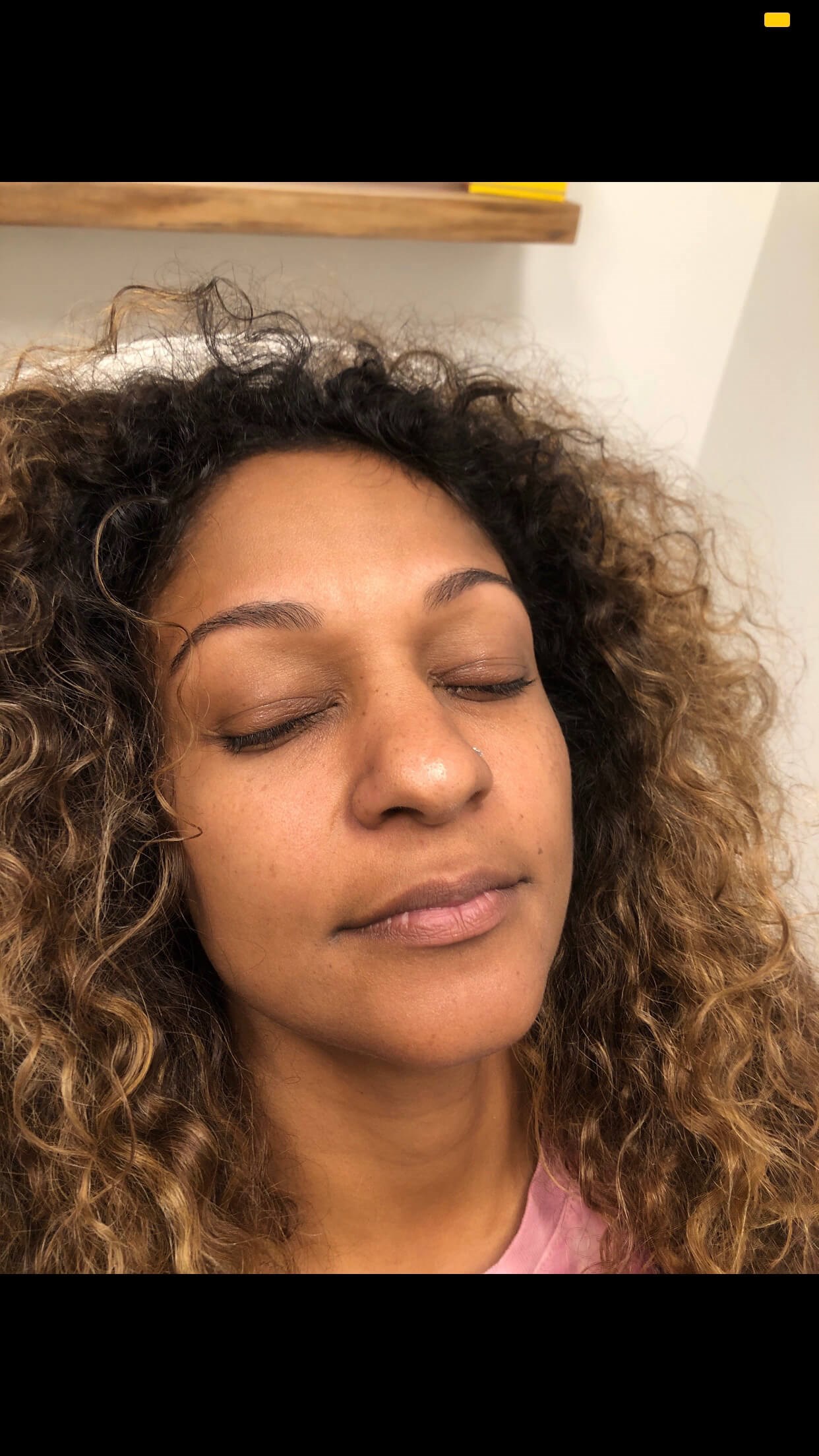 Juvederm Lip Enhancement Before
