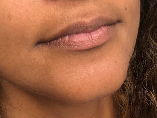 Juvederm Lip Enhancement Before