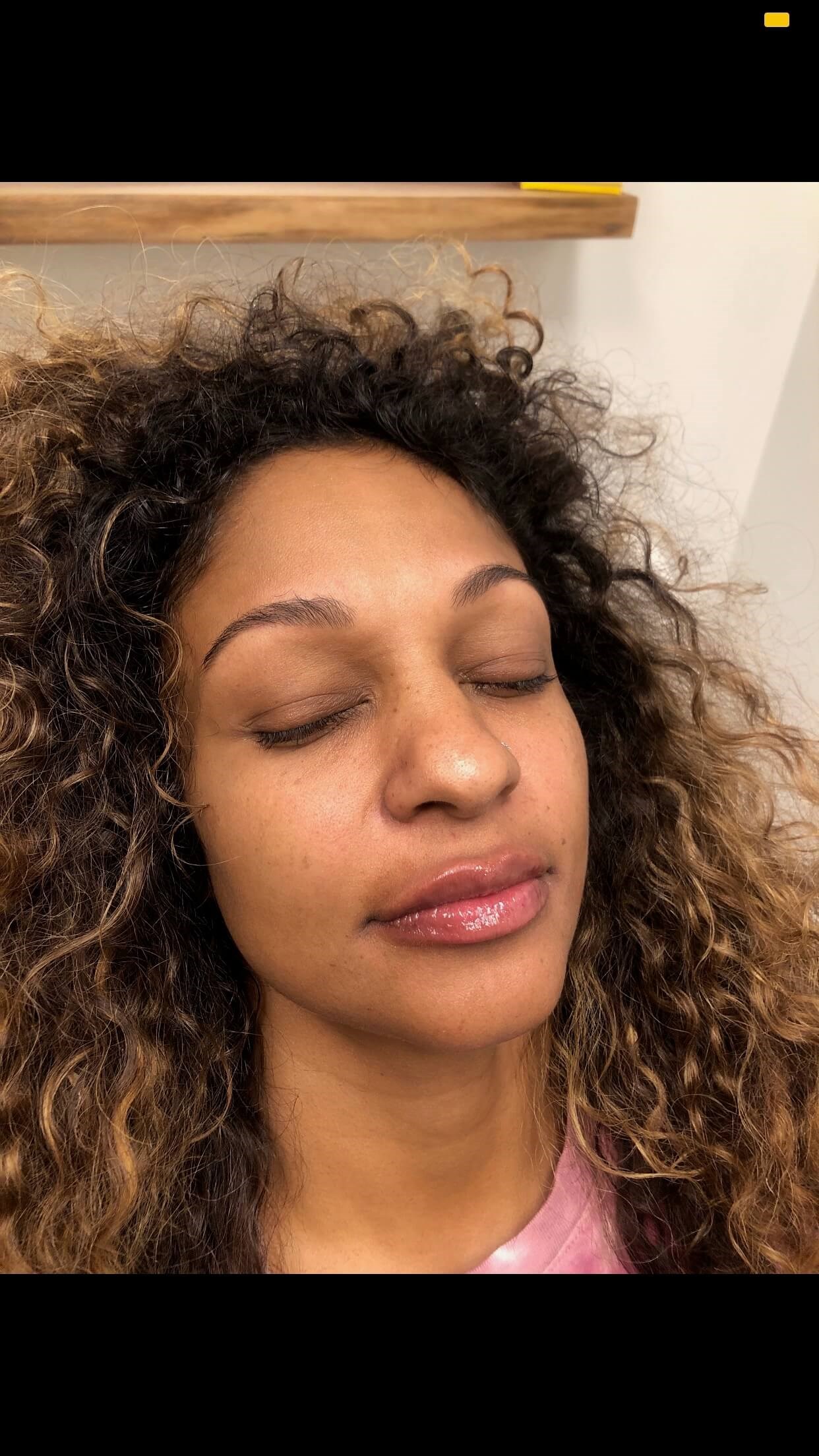 Juvederm Lip Enhancement After