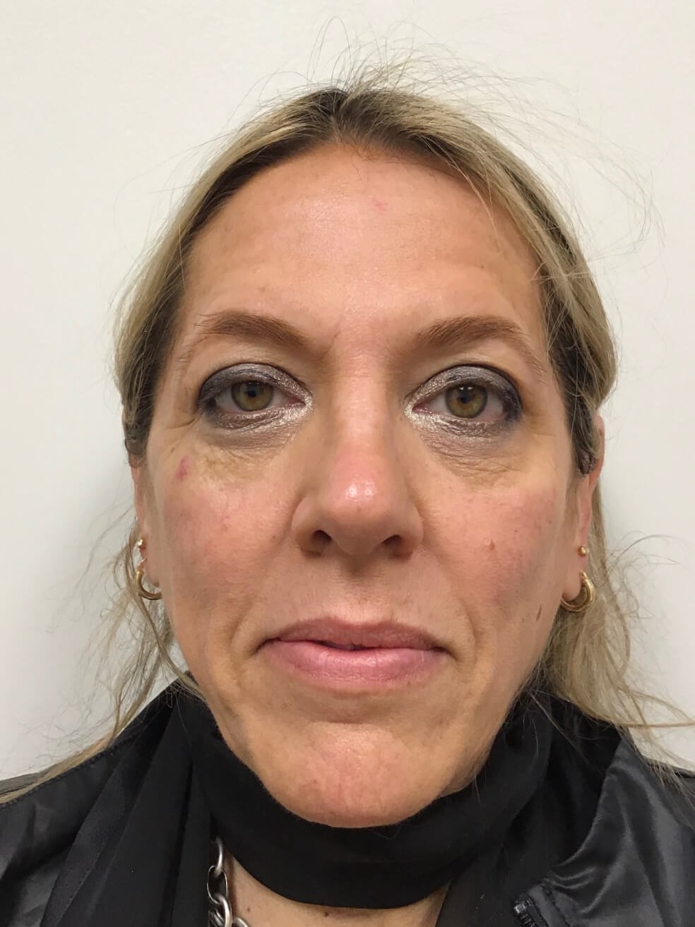 Sculptra Facial Enhancement Before