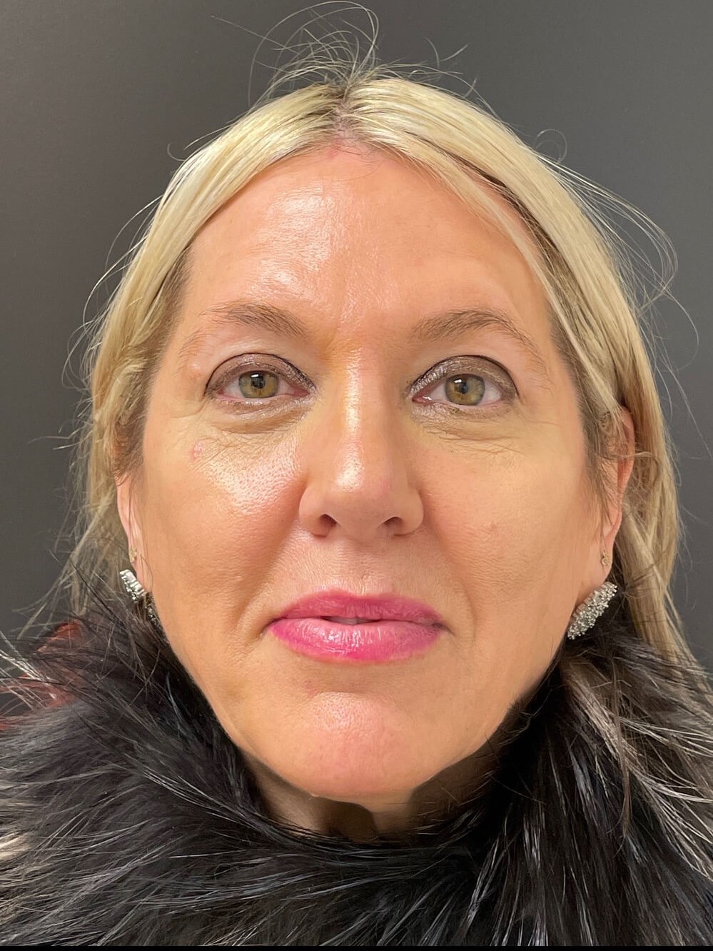 Sculptra Facial Enhancement After