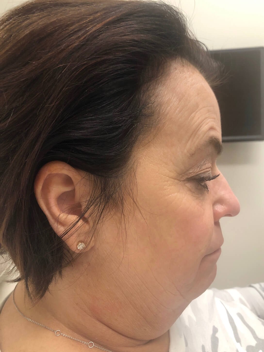Kybella Chin Treatment Before