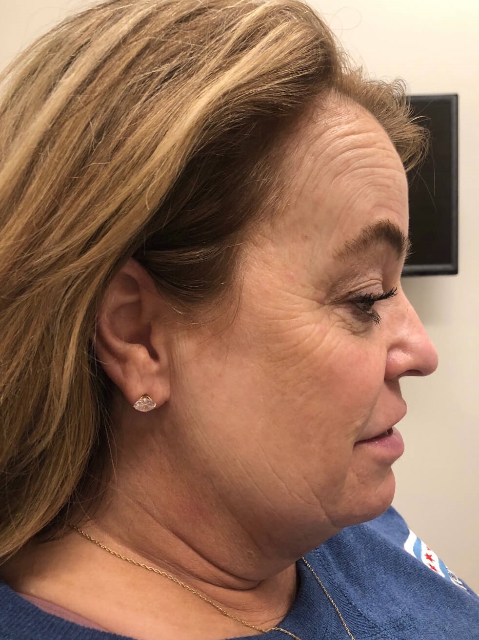 Kybella Chin Treatment After