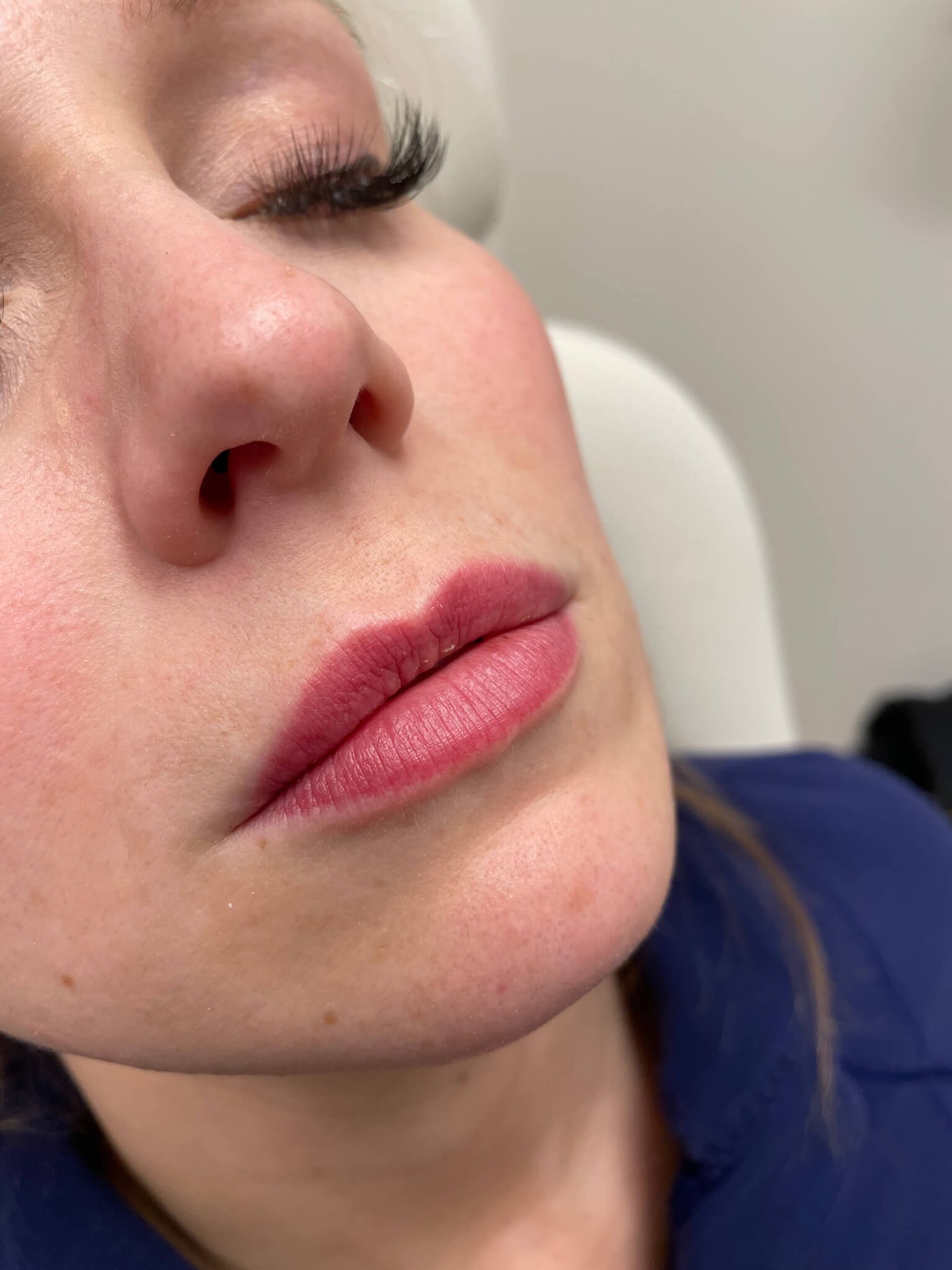 Juvederm Lip Enhancement Before