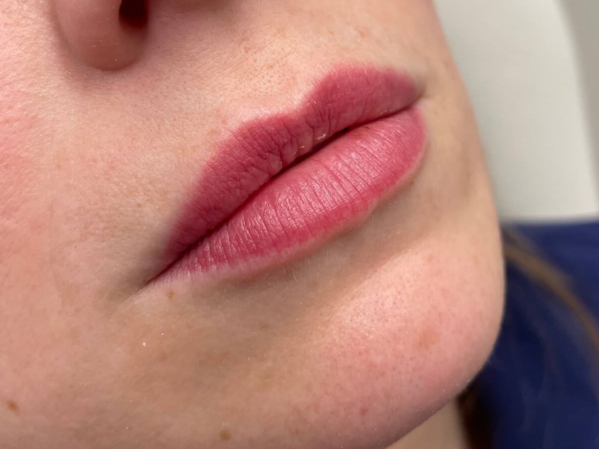 Juvederm Lip Enhancement Before