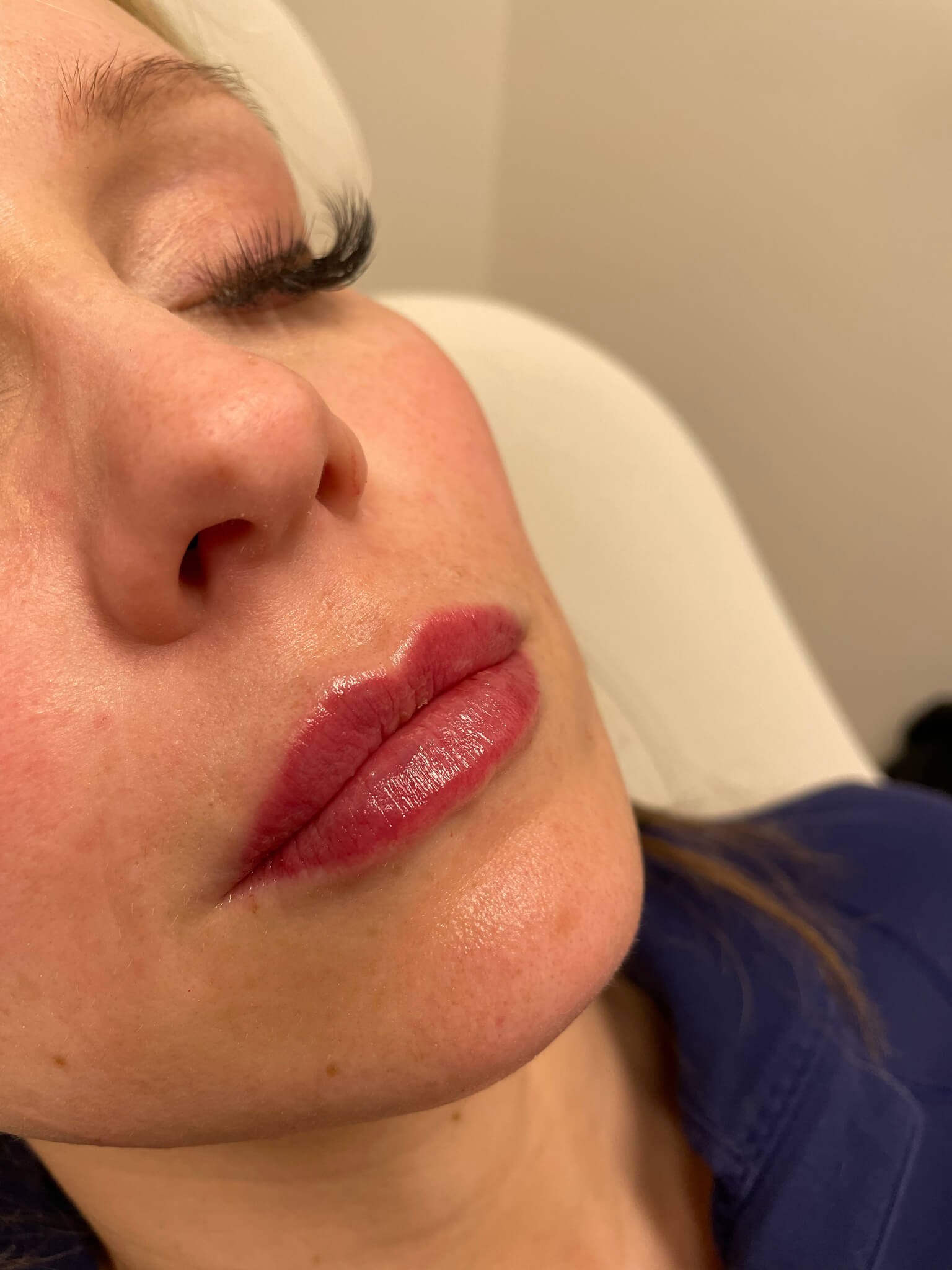 Juvederm Lip Enhancement After