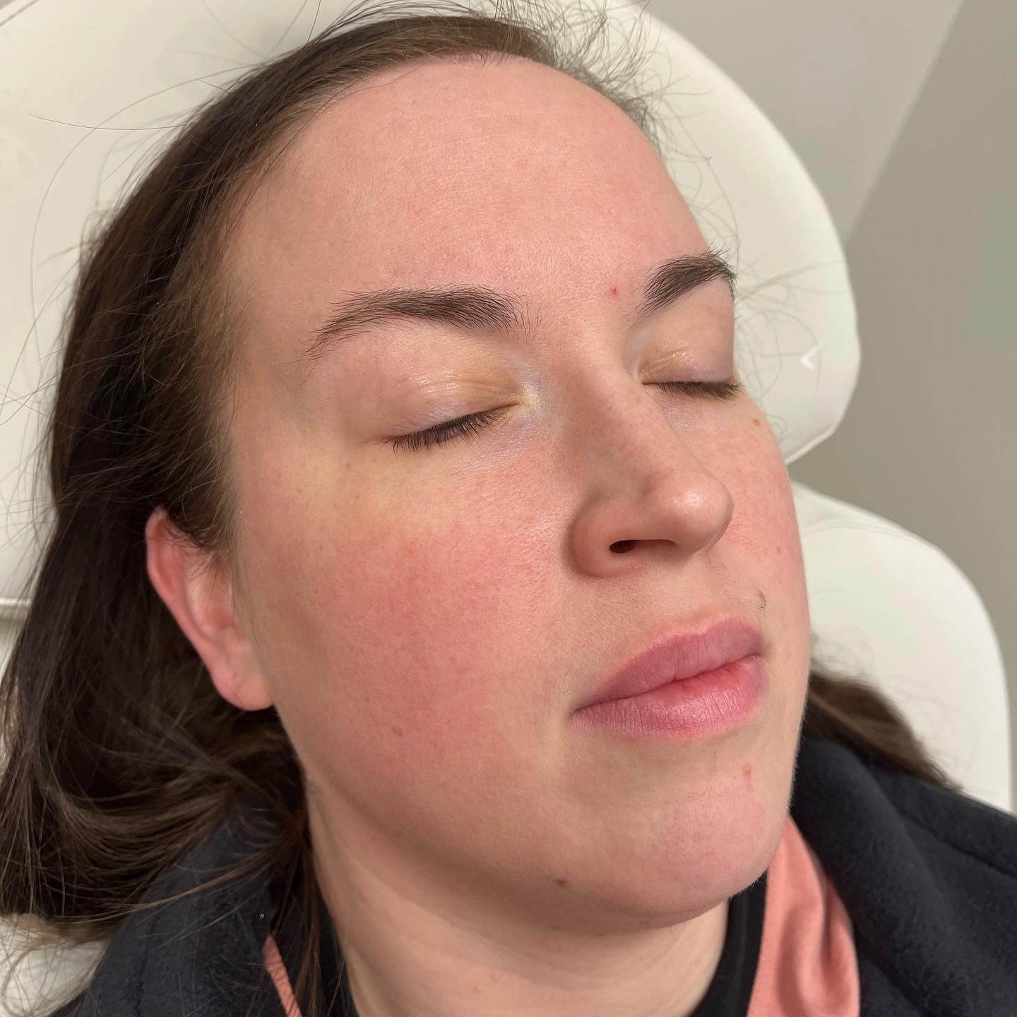 Juvederm Lip Enhancement Before