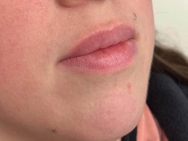 Juvederm Lip Enhancement Before