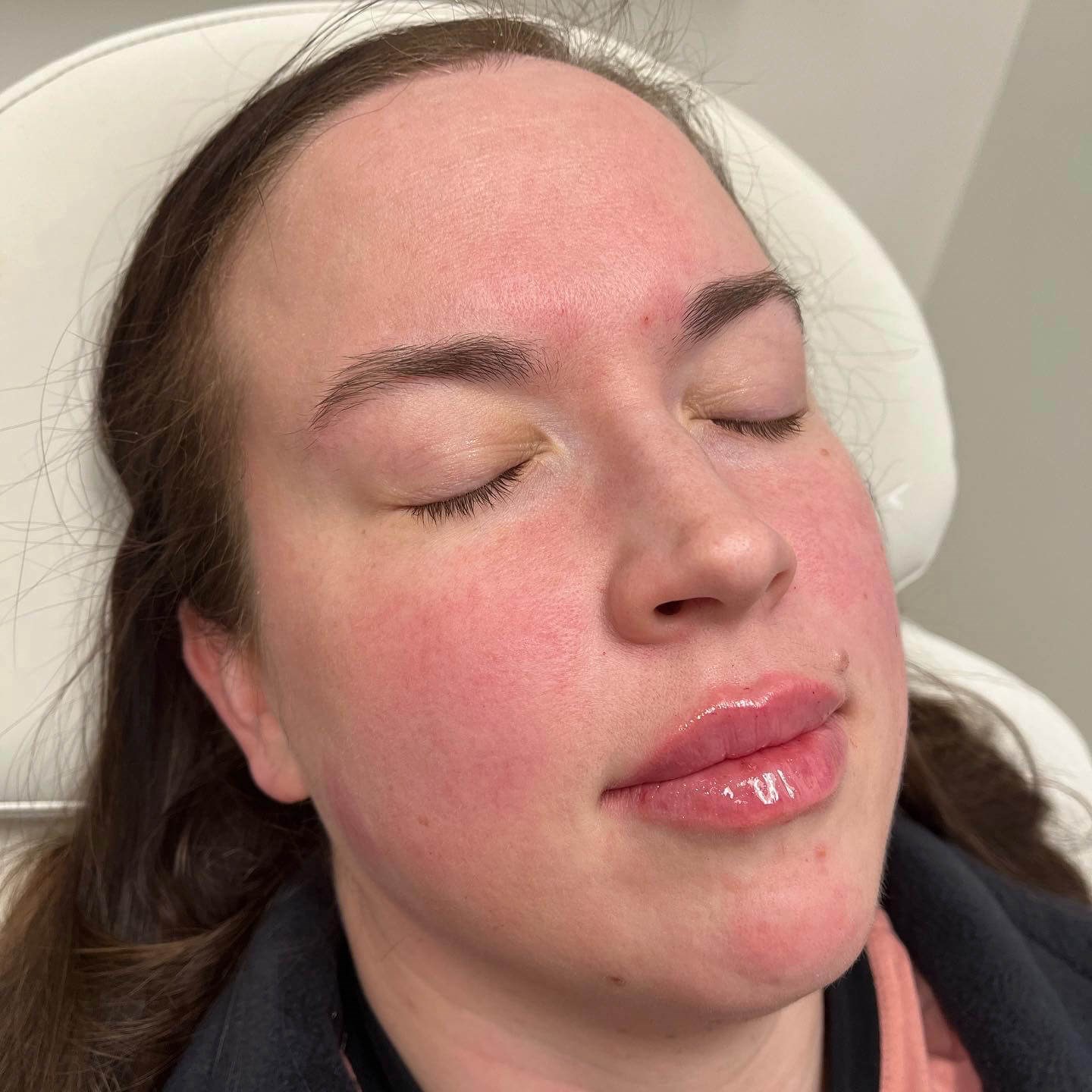 Juvederm Lip Enhancement After