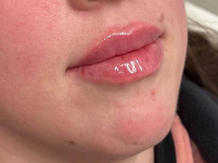 Juvederm Lip Enhancement After