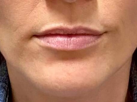 Restylane Lip Enhancement Before