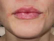 Restylane Lip Enhancement After