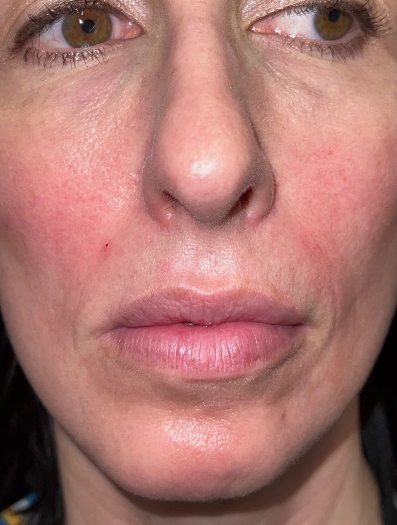 Juvederm Lip Enhancement Before