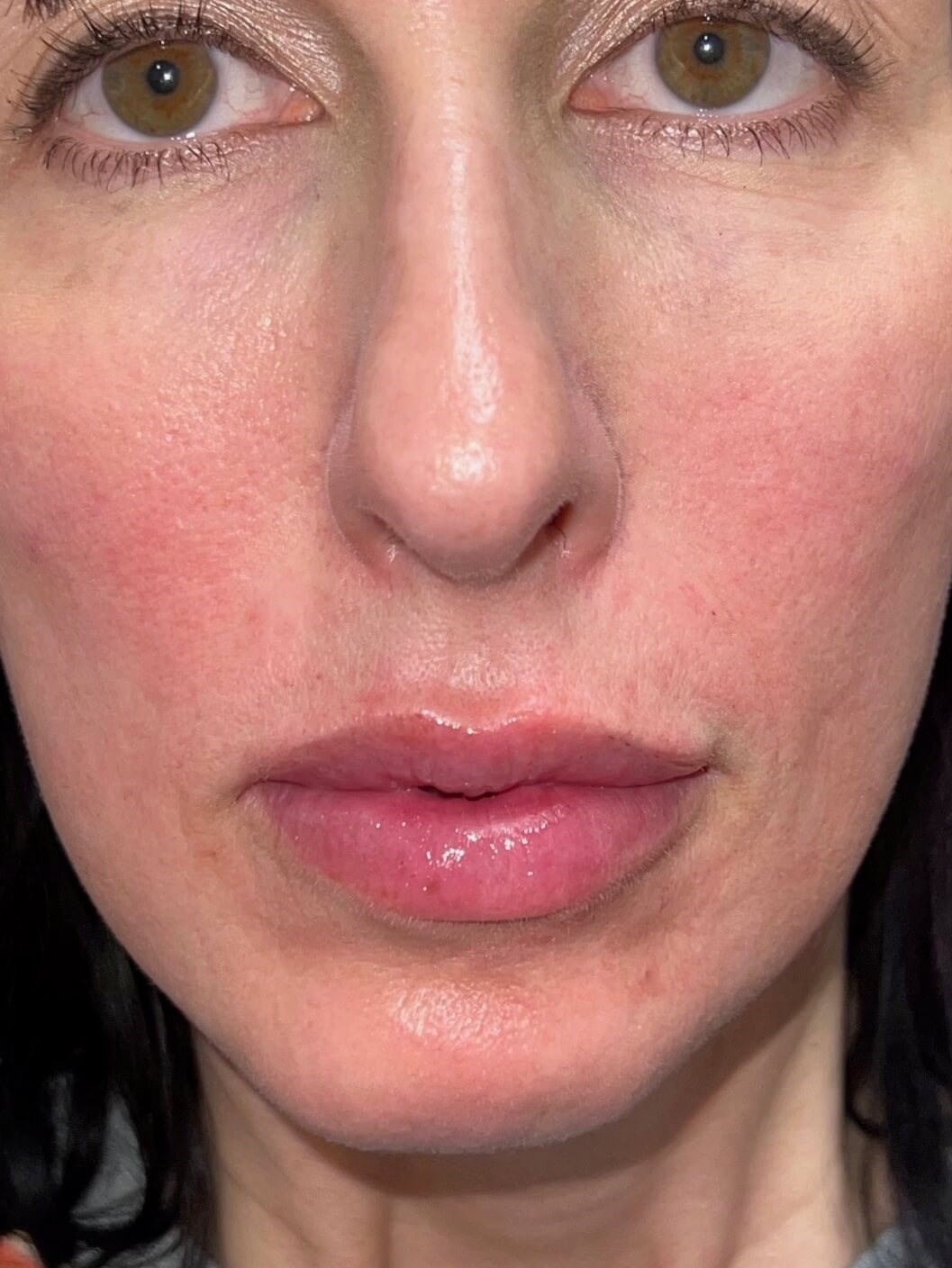 Juvederm Lip Enhancement After
