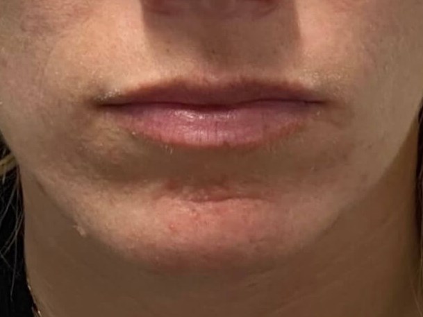 Juvederm Lip fillers Before