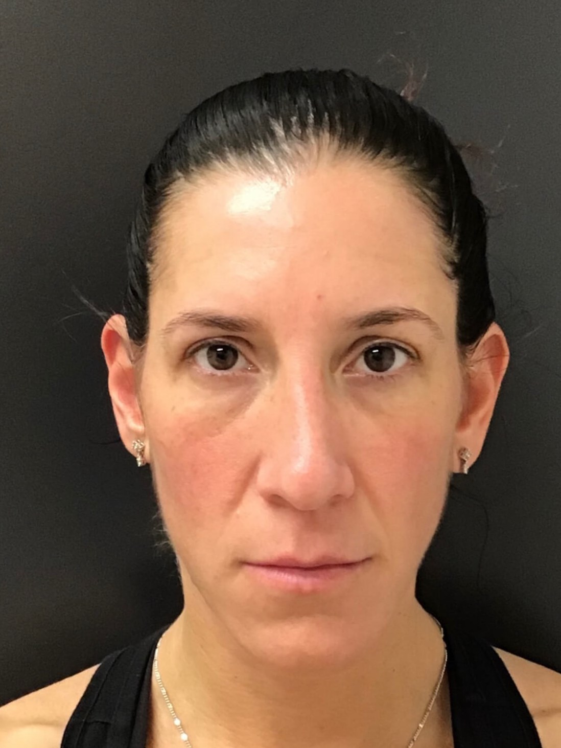 Juvederm Face Enhancement Before