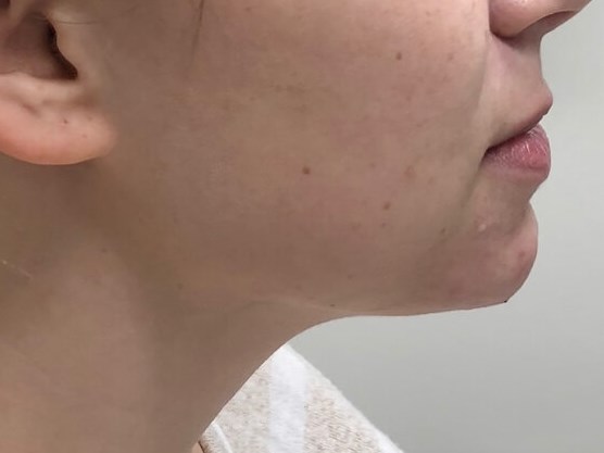Restylane Chin Enhancement After