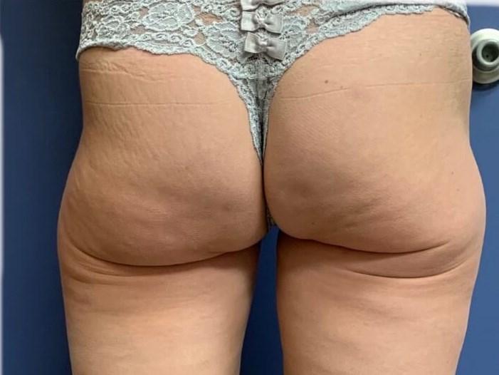Emsculpt Buttocks Before