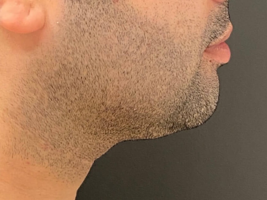 Kybella Chin Treatment After