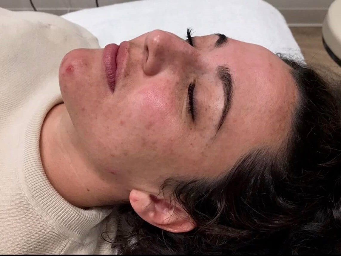 Face Chemical Peel Before