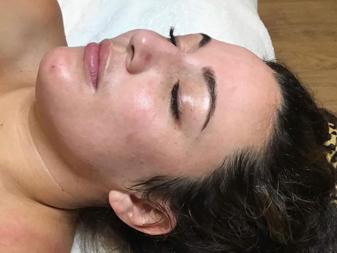 Face Chemical Peel After