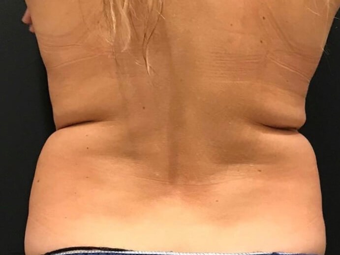 CoolSculpting flank/back Before