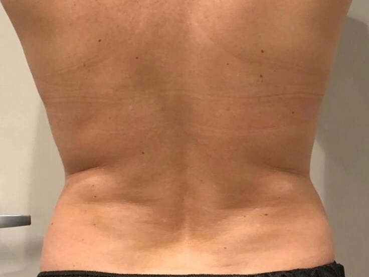 CoolSculpting flank/back After