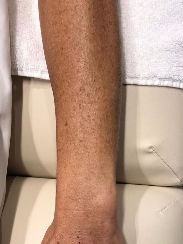 Forever Young Photofacial Before