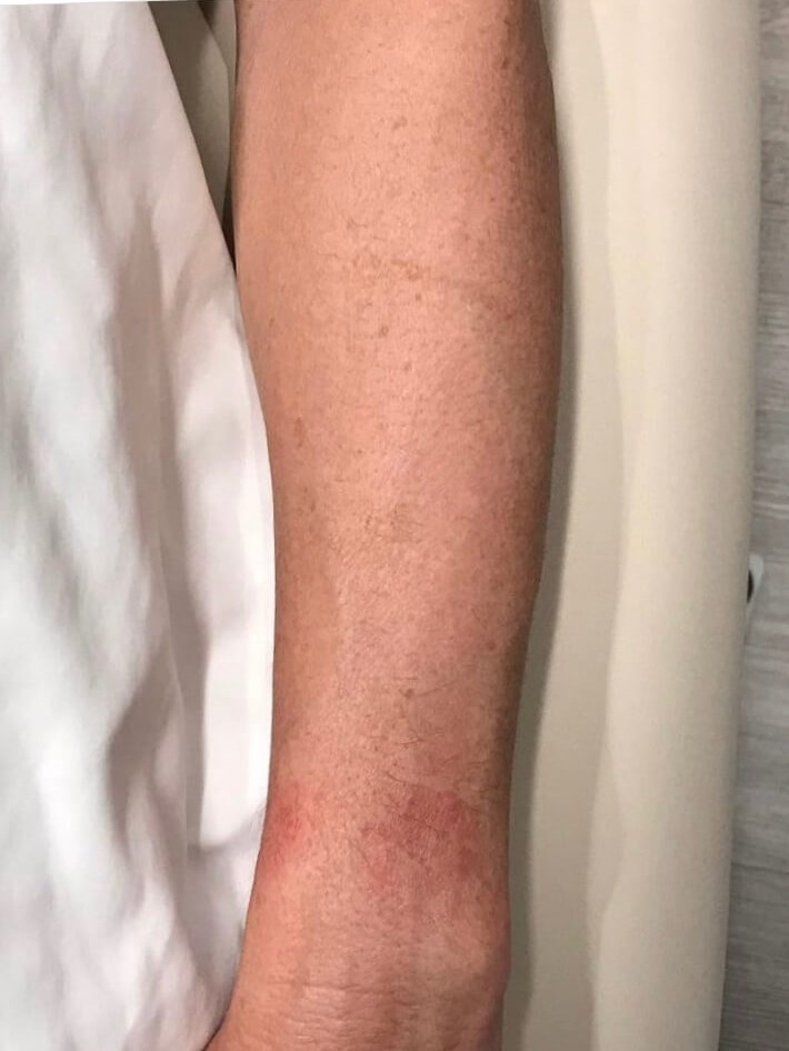 Forever Young Photofacial After