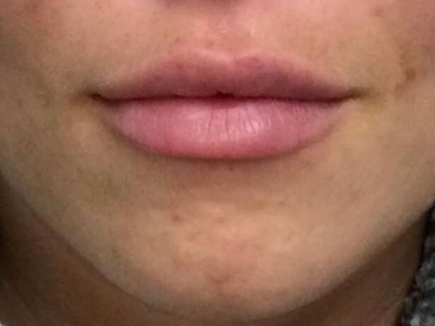Juvederm Lip Enhancement After