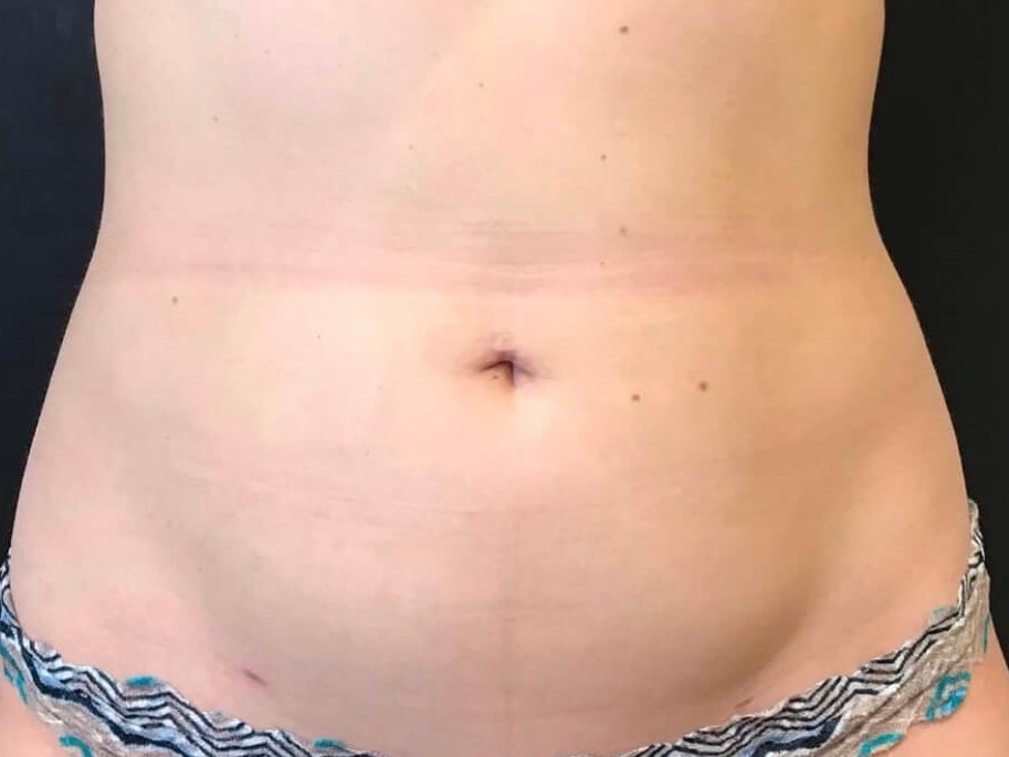 Emsculpt Abdomen Before