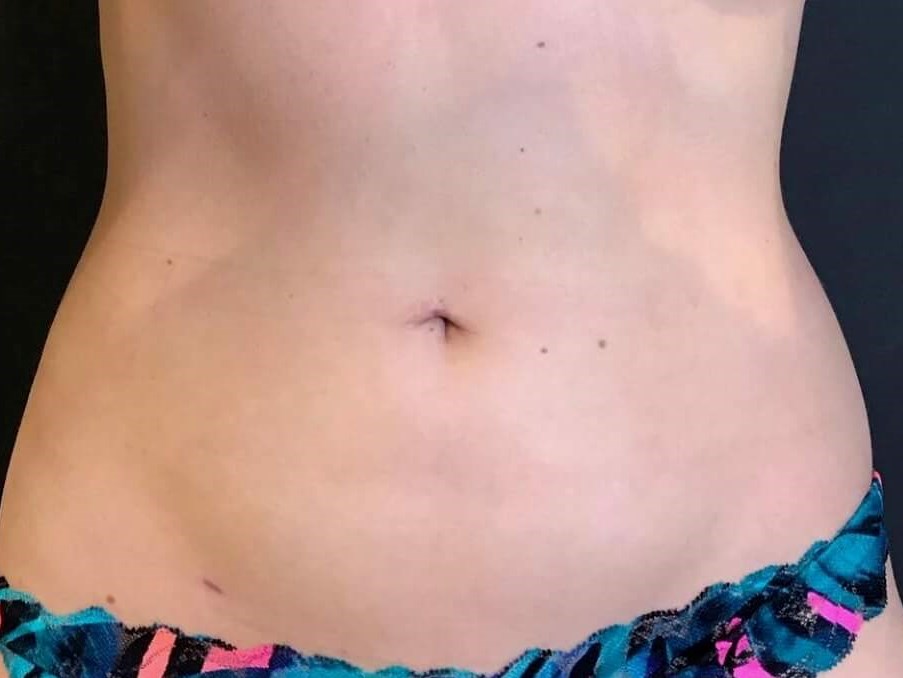 Emsculpt Abdomen After