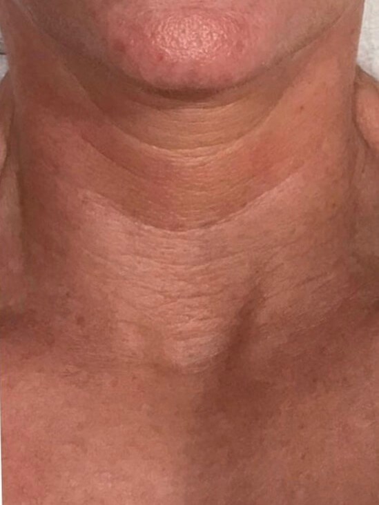 Exilis Skin Tightening Neck Before