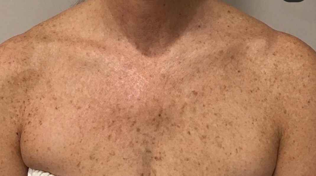 Halo Laser Sun Damage Before