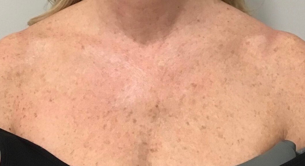 Halo Laser Sun Damage After