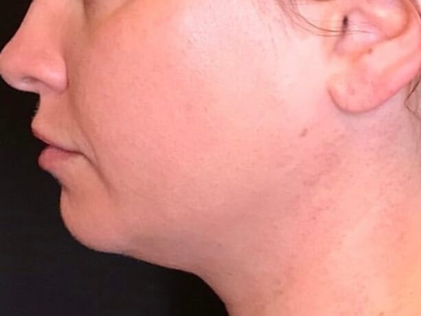 Kybella Submental Fullness Before