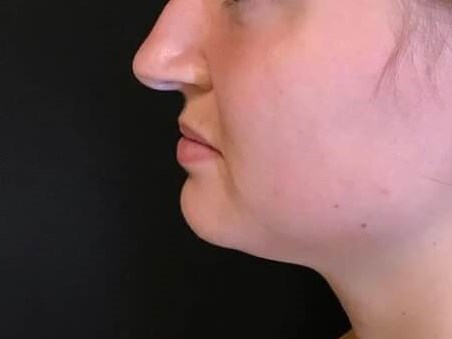 CoolSculpting chin area Before