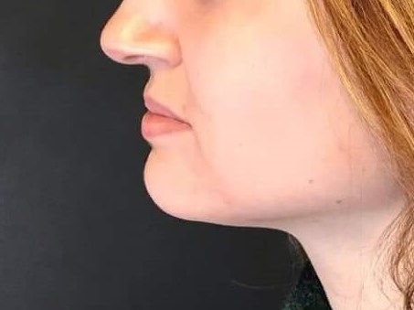 CoolSculpting chin area After