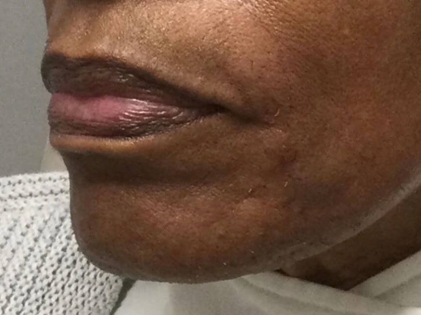 Restylane Perioral lines After