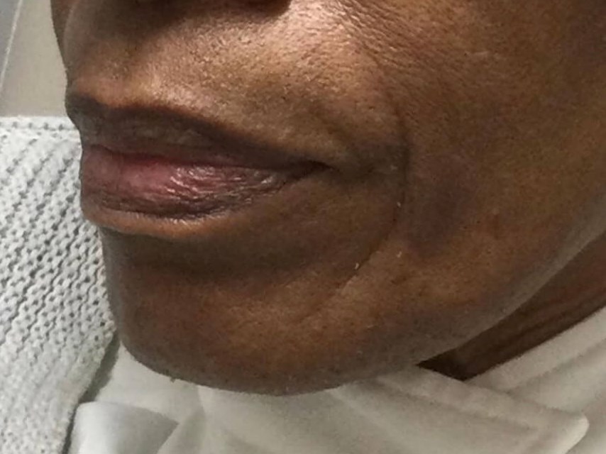 Restylane Perioral lines Before