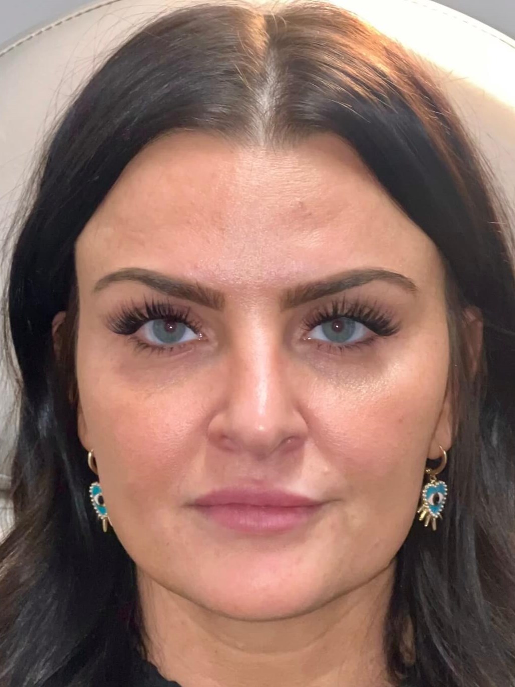 Juvederm Lip Enhancement Before