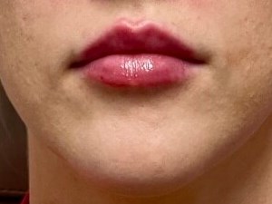 Restylane Kysse lip filler After