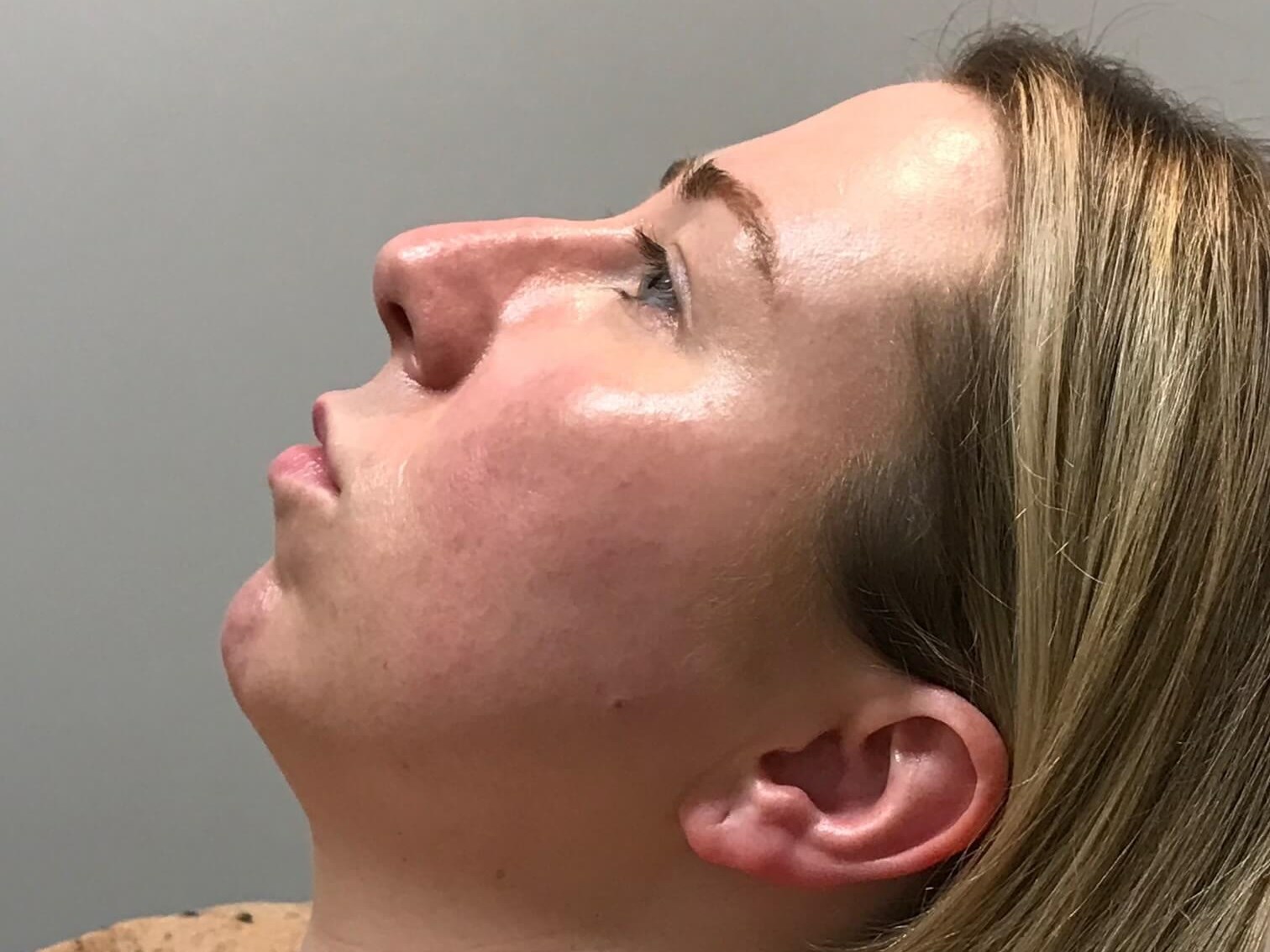 Juvederm Chin Enhancement Before
