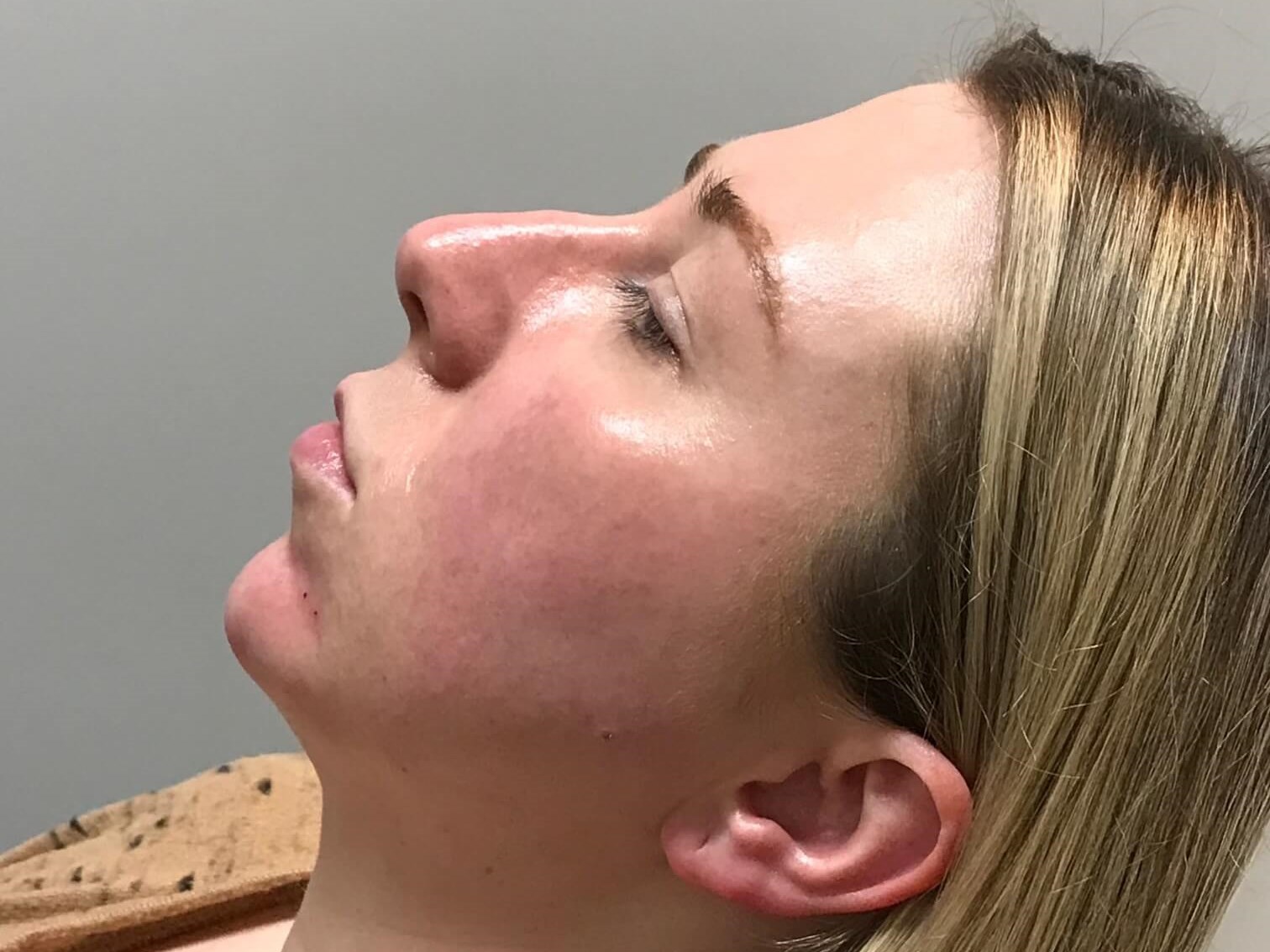Juvederm Chin Enhancement After