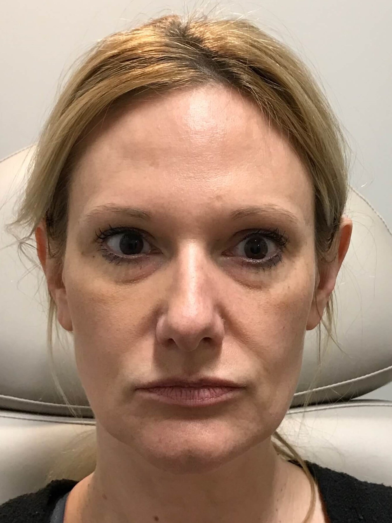 Juvederm Face Enhancement Before