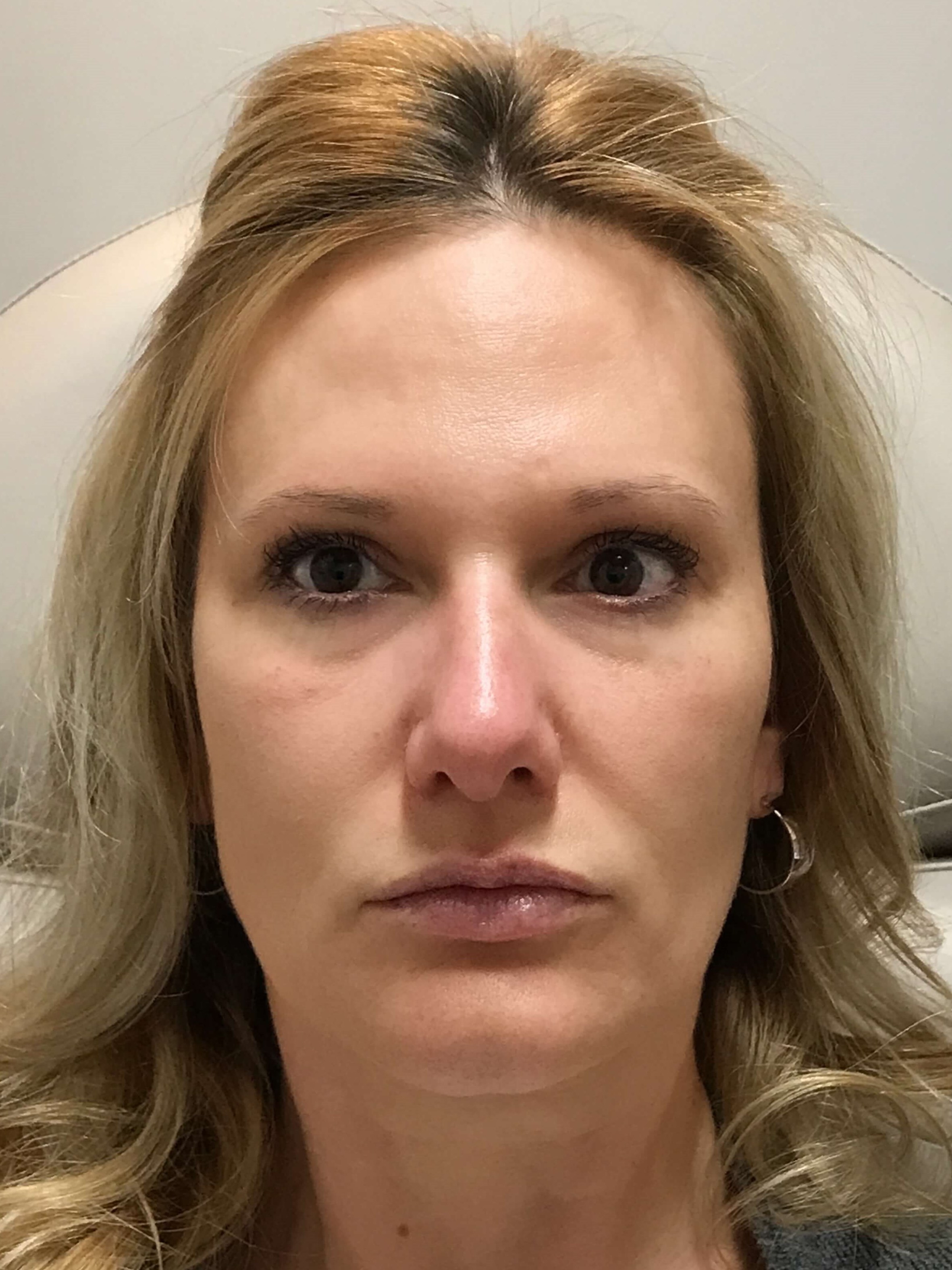 Juvederm Face Enhancement After