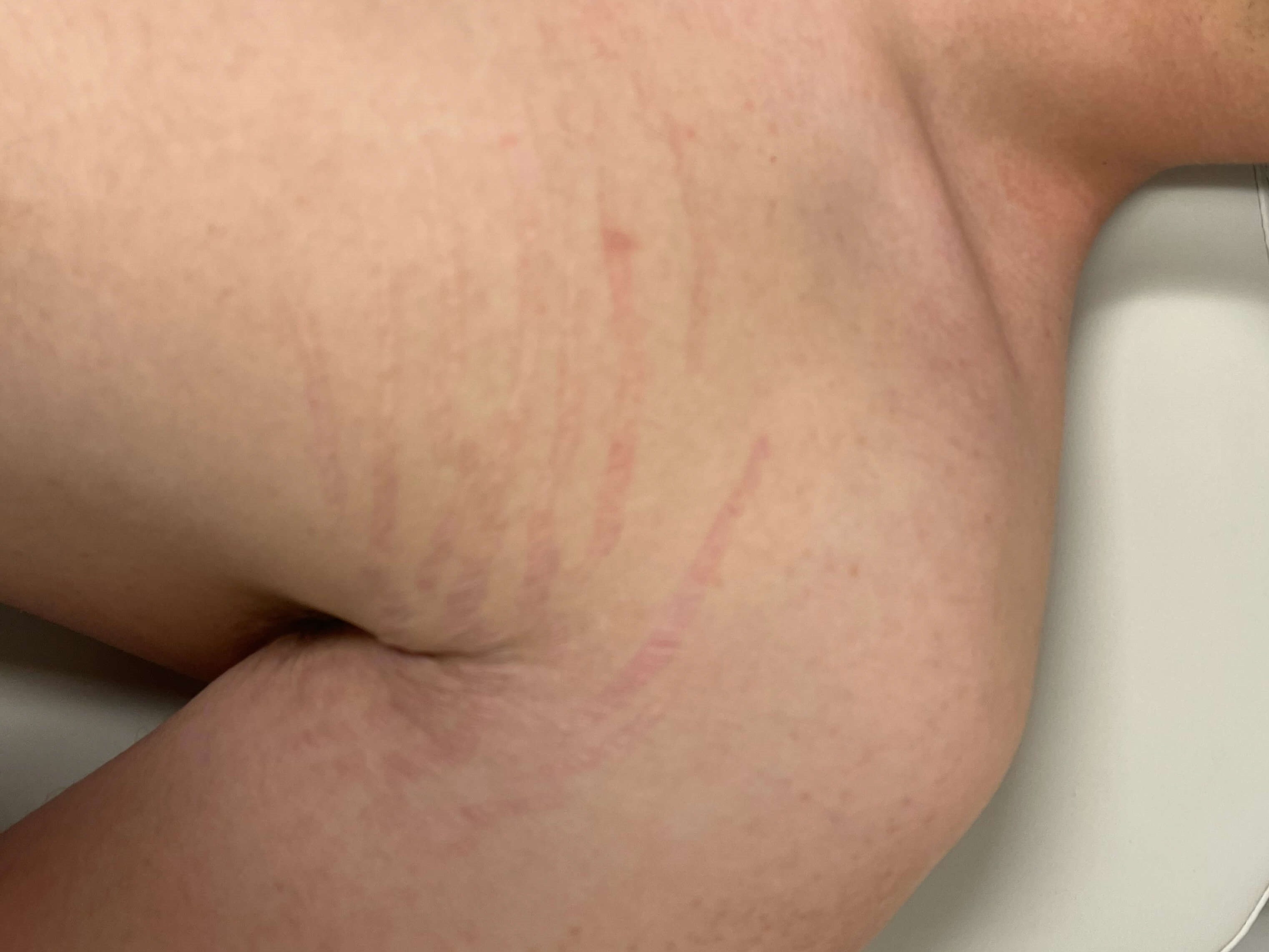 BBL Laser stretch marks After