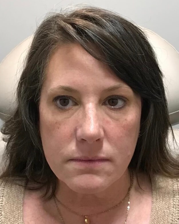 Juvederm Face Enhancement Before