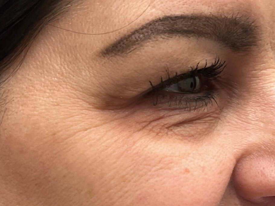 Botox crow's feet Before